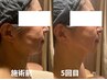 【美肌ケア×深部導入】グロッティ美肌フェイシャル×幹細胞ケアでツヤモチ肌