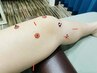 【階段がつらいその膝に鍼灸という選択肢を】膝の鍼灸施術/30分