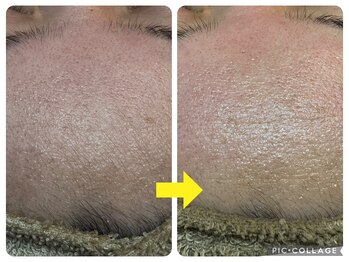 アルマ(ALMA)/額の毛穴ケアできてますか?