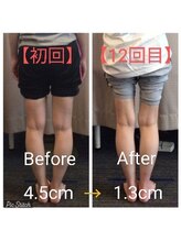 クシロ鍼灸整骨院/【O脚矯正】施術例