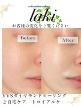 リラクゼーションサロン ラキ(laki)/VVSダイヤモンドピーリング