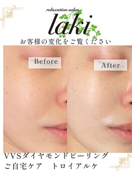 リラクゼーションサロン ラキ(laki)/VVSダイヤモンドピーリング