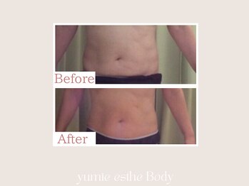 トータルビューティー ゆみえエステ(Total Beauty)/ 痩身/マグシェイプ ウエスト