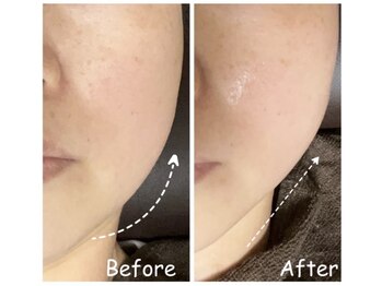 ラ ルーチェ 星田の写真/【年齢肌エイジングケアコース】シワ・リフトアップに♪