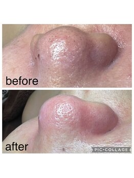 ベルダ(Beldad)/二刀流毛穴エクストラクション