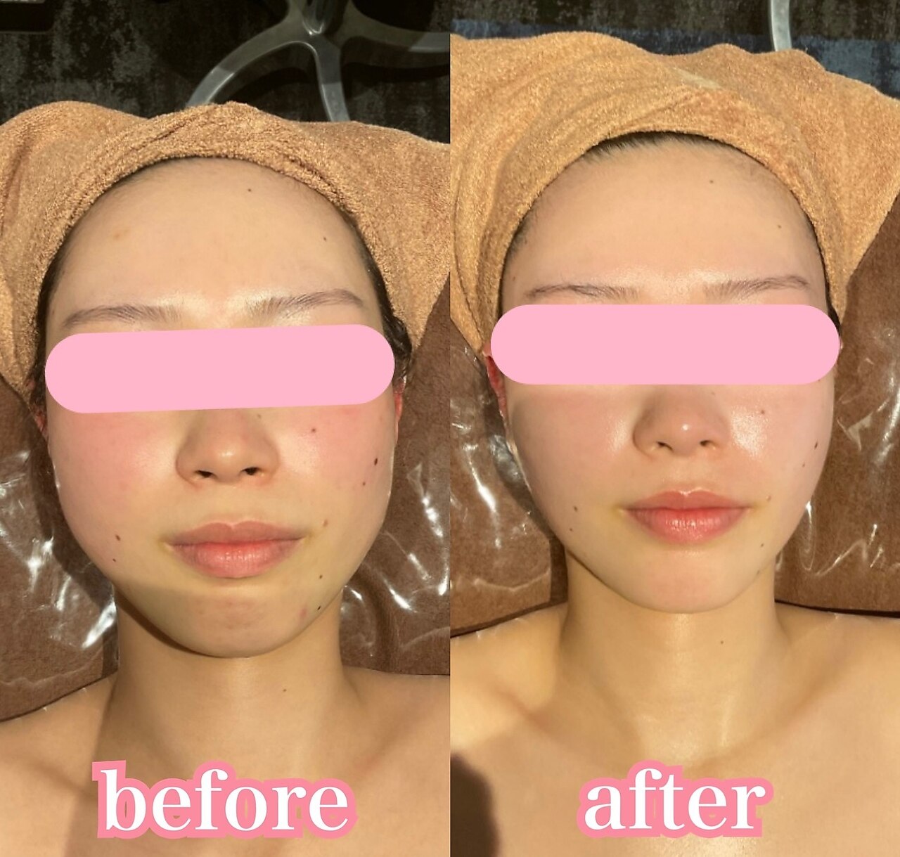 サーマルフラクショナル ☆ お顔の凸凹ケア リフトアップ に