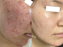 サロンドリー(salon de Re)/肌質改善/ニキビケア