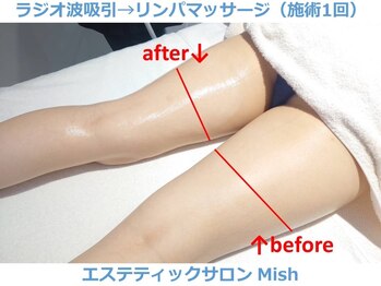 ミッシュ(Mish)/ラジオ波×リンパマッサージ