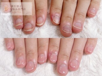 グレースレディ 神戸北店/神戸/深爪矯正/フィルイン