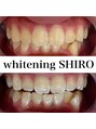 福岡ホワイトニングシロ 天神中洲店(福岡ホワイトニングSHIRO) 【美歯口ホワイトニング】before/after