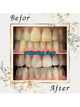 ホワイトニングショップ 宇都宮店/Before&After美白ホワイトニング