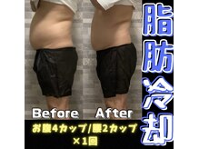 脂肪冷却痩身★メンズもOK◎