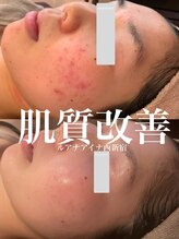 ルアナアイナ(Luana Aina)/ハーブピーリングでニキビケア