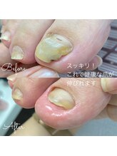 ランランネイル(rangrang nail)/変形爪ケアで元の爪を取り戻す