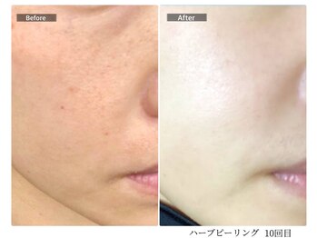 エミルカ 宮崎店(EMILUCA)/【クーポン有】フェイシャル症例