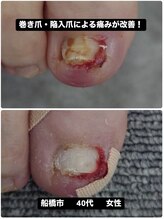 巻き爪じゅん 千葉駅前店/陥入爪の痛み根本から改善