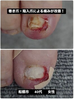 巻き爪じゅん 千葉駅前店/陥入爪の痛み根本から改善