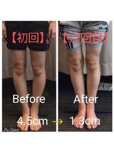 クシロ鍼灸整骨院/【O脚矯正】施術例