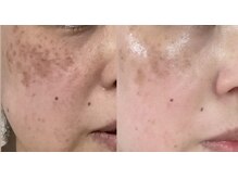 コンディションスキン(condition skin)の雰囲気(マツヤニWaxクレイパック育菌スキンケアを一年半継続した結果♪)