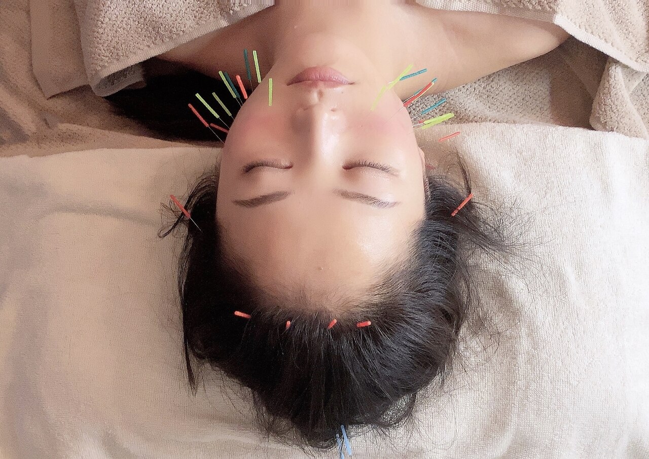 【短時間で小顔効果を実感♪】小顔電気鍼+ドライヘッドスパ☆小顔鍼40分A