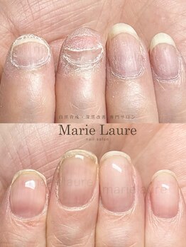 マリーロール 梅田店(Marie Laure)/自爪育成/深爪矯正/ネイルケア