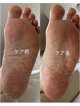 おん/角質ケア【70代女性】