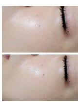 エスボーテ(sbeaute)/プラズマ+ダクトピール