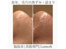ルーモアンド(Lumo&)の雰囲気（黒ずみ/毛穴詰まり/ざらつき/くすみ肌/肌質別オーダーケア）