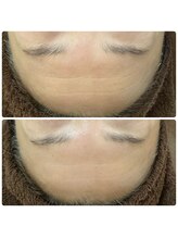 アイリス(AIRIS)/シワにお悩みの方