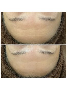 アイリス(AIRIS)/シワにお悩みの方