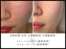 韓国肌管理室 ソア(soa)/【DTなしの一度の効果】