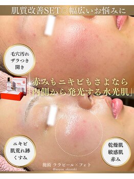 ソユ(SOYOU)/施術* ララピール×フォト