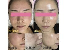 ミ ジュエル(me jewel)/ハーブピーリング導入直後から