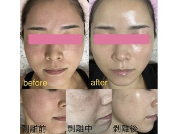 ミ ジュエル(me jewel)/ハーブピーリング導入直後から