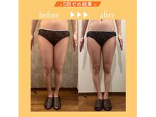 ビューティースタイリング 恵比寿店(beauty styling)の雰囲気（分厚い脂肪も燃焼させるラフォス♪ボディラインをしっかり造形☆）