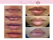 ビューティーリバース 湘南ちがさき店/ローマピンク_リップ施術例
