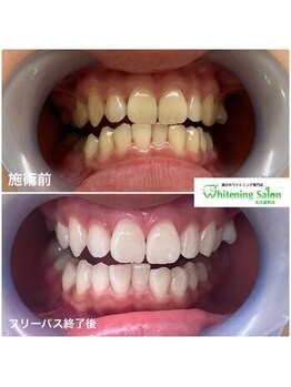 ホワイトニングサロン 名古屋駅店/【ホワイトニング施術例】