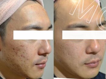 パトラ 難波店/ハーブピーリング★肌質改善