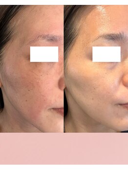 リンクアンドボーテ 大垣(Link&Beaute)/肌改善.エイジングケア