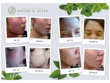 小顔クイーン 荻窪店/しつこく繰り返すニキビケアに