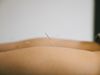 アキュネ 福岡薬院店(acune)/福岡/薬院/美容鍼/美肌