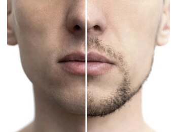 バーグトータルビューティー(bague total beauty)/ヒゲ脱毛がメンズに大人気！！