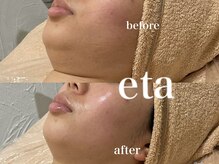 エタ(eta)/小顔施術/輪郭出し