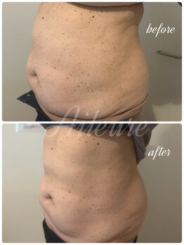 エルール トータルビューティ(Aileure total beauty)/脂肪燃焼ジェル