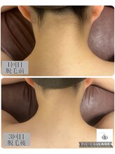 アンドココ(&coco)/脱毛