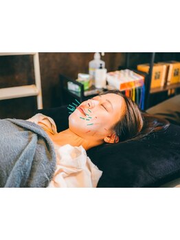 鍼灸施術を受けたい