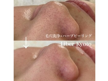リベルキョウト 京都駅前店(Liber Kyoto)/毛穴レス艶肌コース