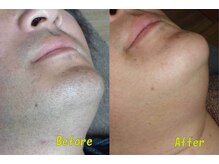 こふこふ/ひげの施術