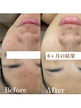 フォルチェ ゆめタウン広島店(Folche)/にきびトラブルケア