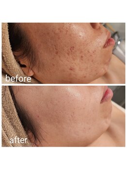 ルオント(LUONTO)/ハーブピーリング症例